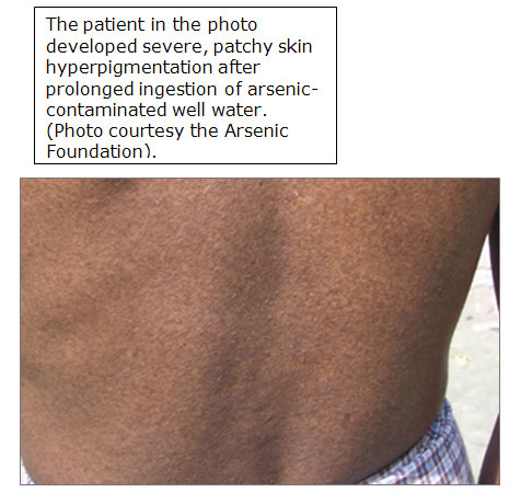 patients back showing patchy skin pigmentation
