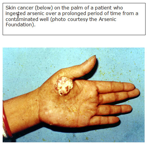 skin cancer on the hand