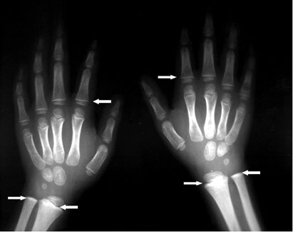 Long Bone Radiograph of Hands