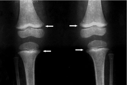 Long Bone Radiograph of Knees