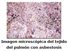La asbestosis es una enfermedad cr%26oacute;nica, grave, y progresiva, de los pulmones que puede empeorar conforme pasa el tiempo