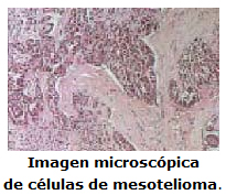 El mesotelioma es un c%26aacute;ncer muy raro de la membrana del t%26oacute;rax o abdomen